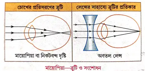 মায়োপিয়া বা নিকটবন্ধ দৃষ্টি সম্পর্কে সংক্ষেপে লেখো