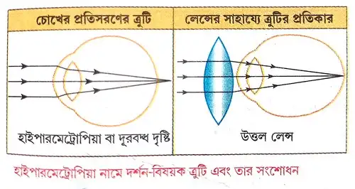 হাইপারমেট্রোপিয়া বা দূরবদ্ধ দৃষ্টি সম্পর্কে ধারণা দাও