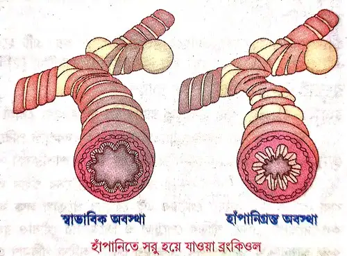 অ্যাজমা বা হাঁপানি কাকে বলে অ্যাজমার পরিবেশগত কারণ সংক্ষেপে আলোচনা করো।