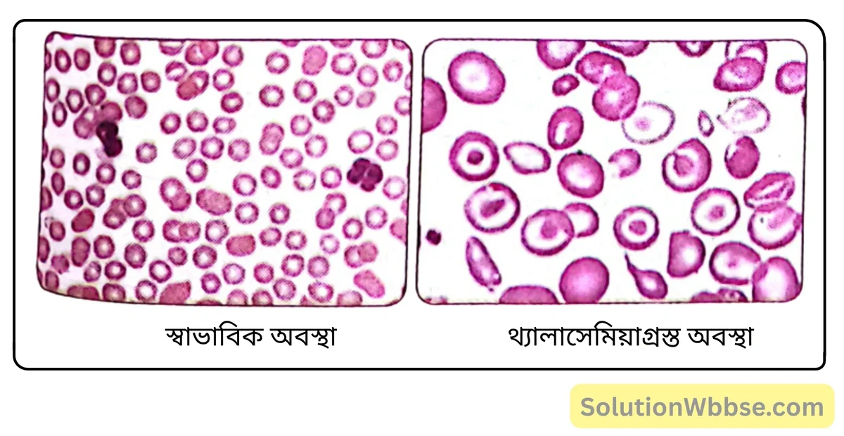 মাধ্যমিক জীবন বিজ্ঞান – বংশগতি এবং কয়েকটি সাধারণ জিনগত রোগ – কয়েকটি সাধারণ জিনগত রোগ – অতিসংক্ষিপ্ত প্রশ্নোত্তর 2 থ্যালাসেমিয়াগ্রস্ত অবস্থায় হ্রাসপ্রাপ্ত RBC