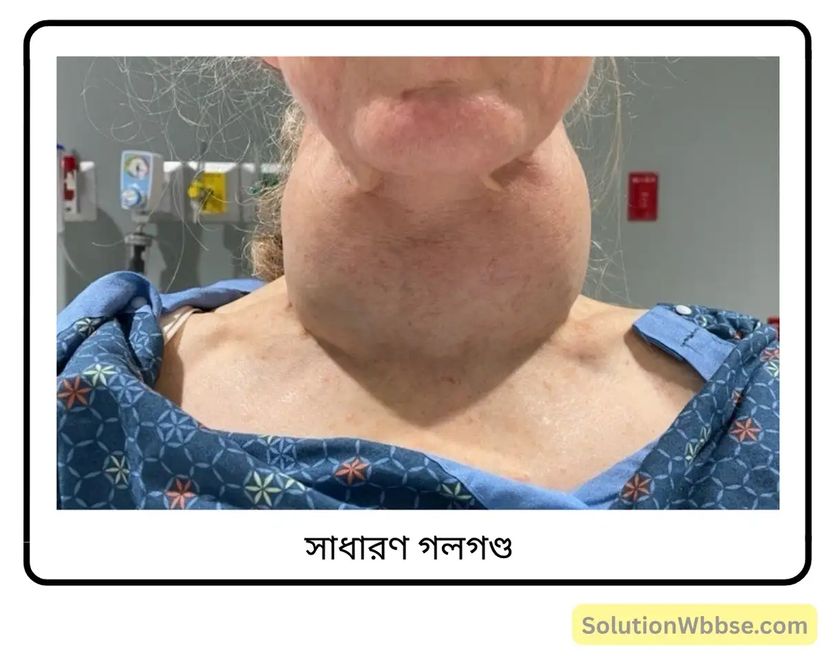 মাধ্যমিক জীবন বিজ্ঞান – জীবজগতে নিয়ন্ত্রণ ও সমন্বয় – প্রাণীদেহে সাড়া প্রদান ও রাসায়নিক সমন্বয় হরমোন – সংক্ষিপ্ত প্রশ্নোত্তর 8 সাধারণ গলগণ্ড-