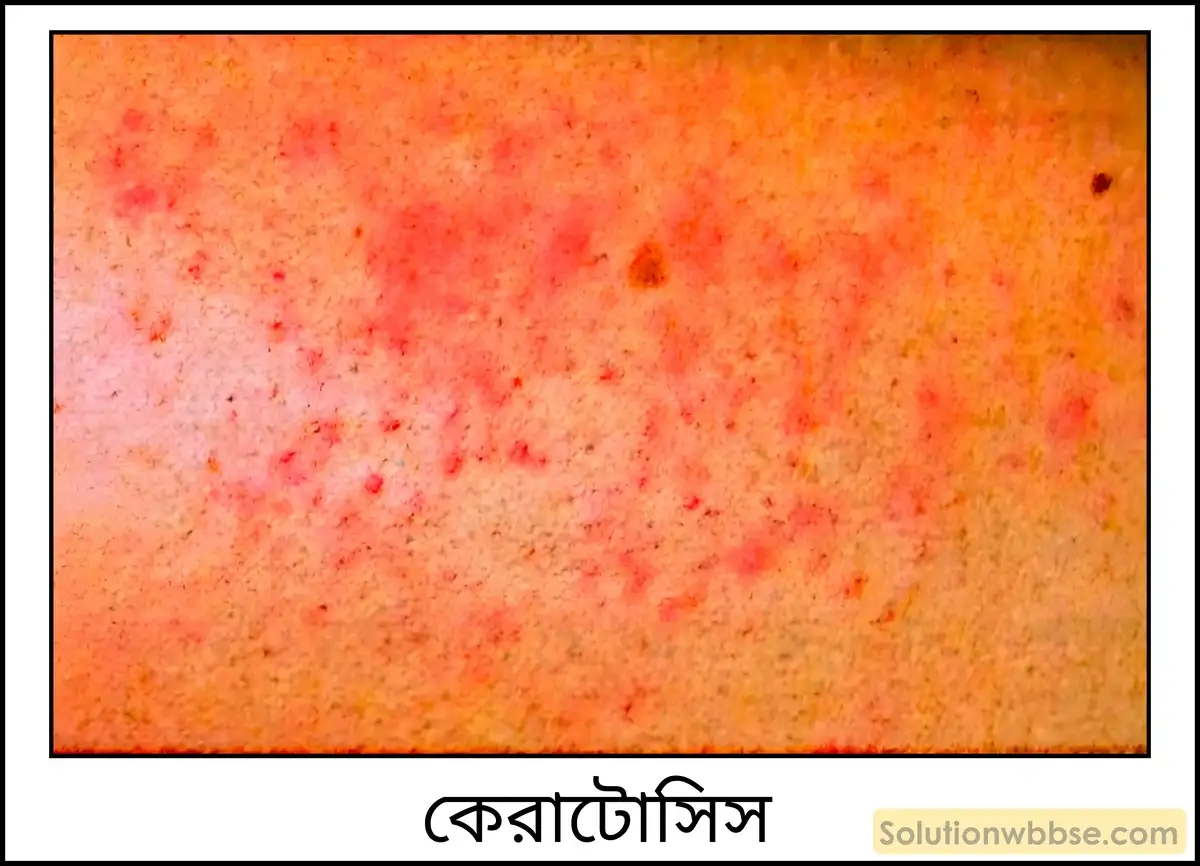 নবম শ্রেণী - ভৌতবিজ্ঞান - পদার্থ : পরমাণুর গঠন ও পদার্থের ভৌত ও রাসায়নিক ধর্মসমূহ - জল - প্রশ্ন ও উত্তর 18 আর্সেনিক দূষণের কুফলগুলি লেখো।