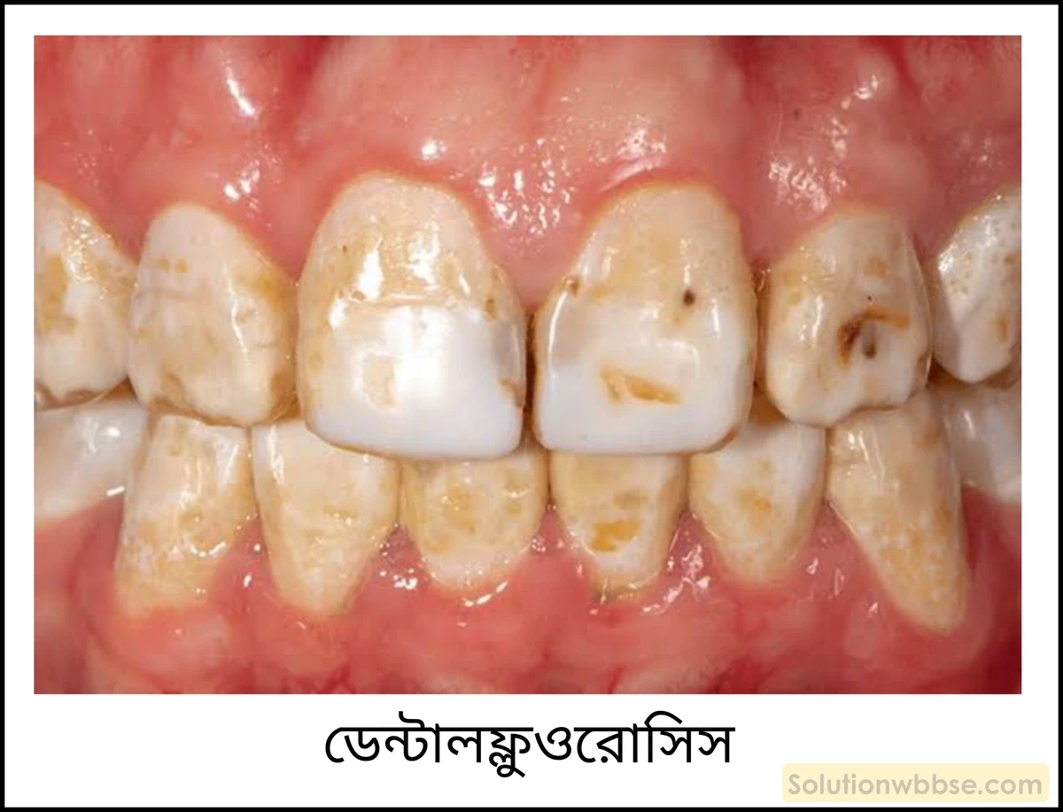 নবম শ্রেণী - ভৌতবিজ্ঞান - পদার্থ : পরমাণুর গঠন ও পদার্থের ভৌত ও রাসায়নিক ধর্মসমূহ - জল - প্রশ্ন ও উত্তর 23 ফ্লুওরাইড দূষণের ক্ষতিকর প্রভাবগুলি লেখো।