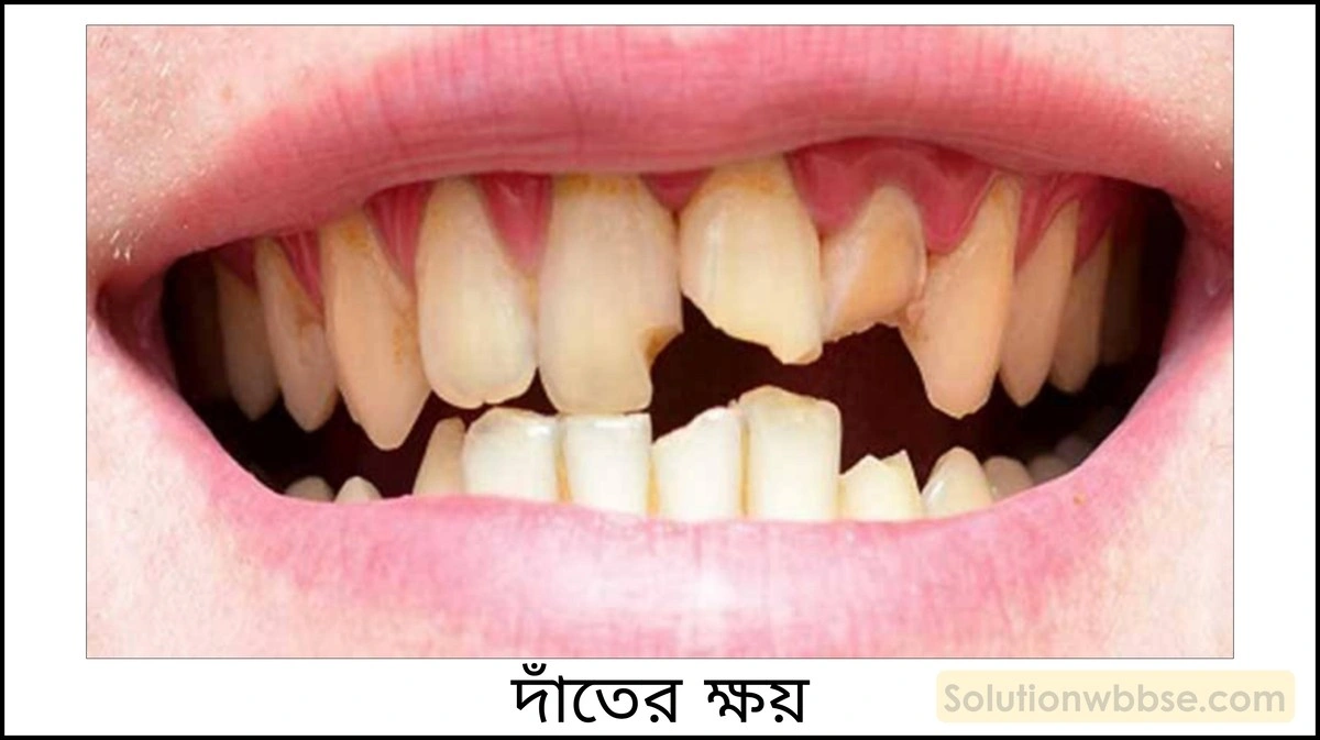নবম শ্রেণী - ভৌতবিজ্ঞান - পদার্থ : পরমাণুর গঠন ও পদার্থের ভৌত ও রাসায়নিক ধর্মসমূহ - অ্যাসিড, ক্ষার, লবণ - প্রশ্ন ও উত্তর 17 দাঁতের ক্ষয়ের ওপর pH -এর প্রভাব ও প্রতিরোধের উপায় সম্বন্ধে লেখো।