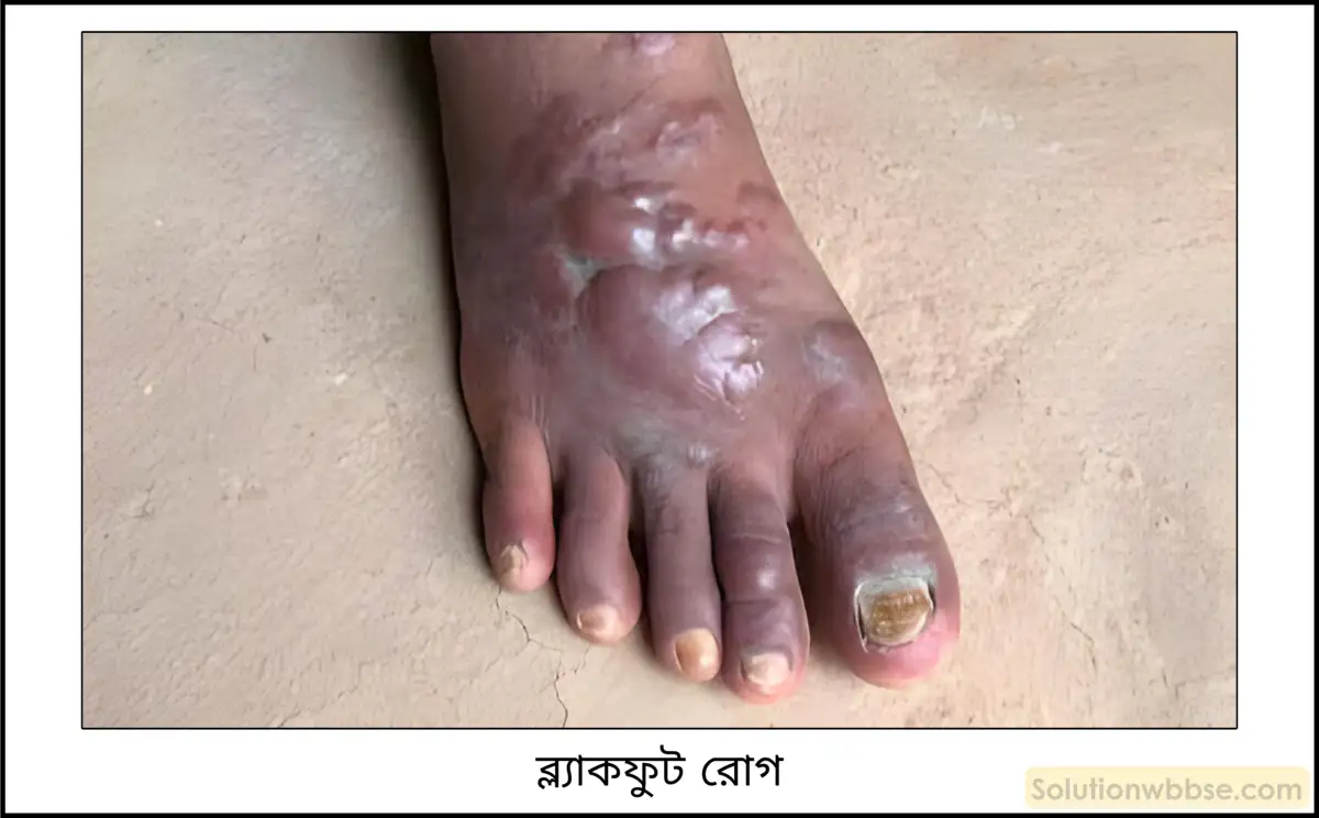 নবম শ্রেণী - ভৌতবিজ্ঞান - পদার্থ : পরমাণুর গঠন ও পদার্থের ভৌত ও রাসায়নিক ধর্মসমূহ - জল - প্রশ্ন ও উত্তর 19 আর্সেনিক দূষণের কুফলগুলি লেখো।