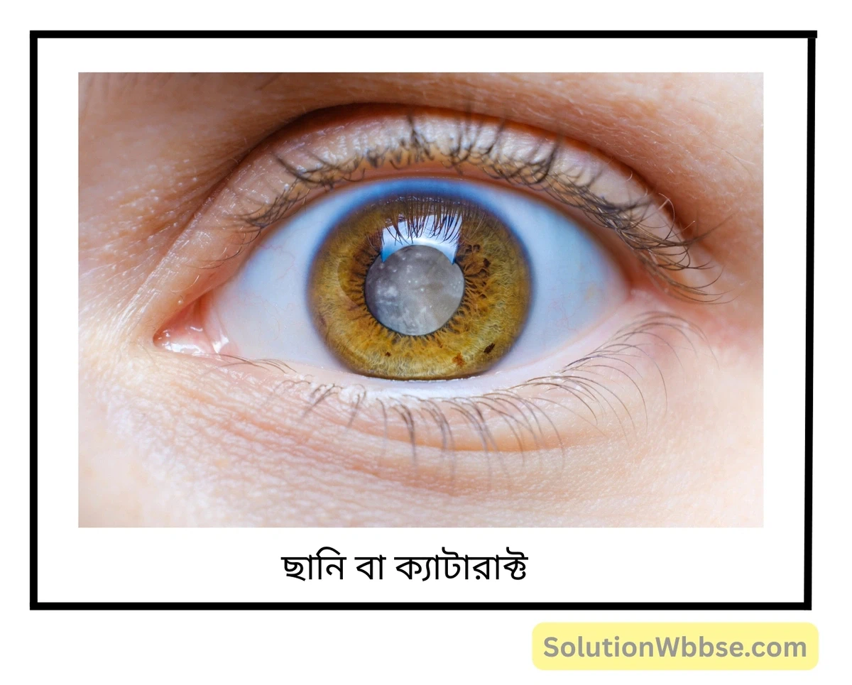 মাধ্যমিক জীবন বিজ্ঞান - জীবজগতে নিয়ন্ত্রণ ও সমন্বয় - প্রাণীদের সাড়াপ্রদান ও ভৌত সমন্বয় - স্নায়ুতন্ত্র - সংক্ষিপ্ত প্রশ্নোত্তর 12 ছানি বা ক্যাটার্যাক্ট (cataract)