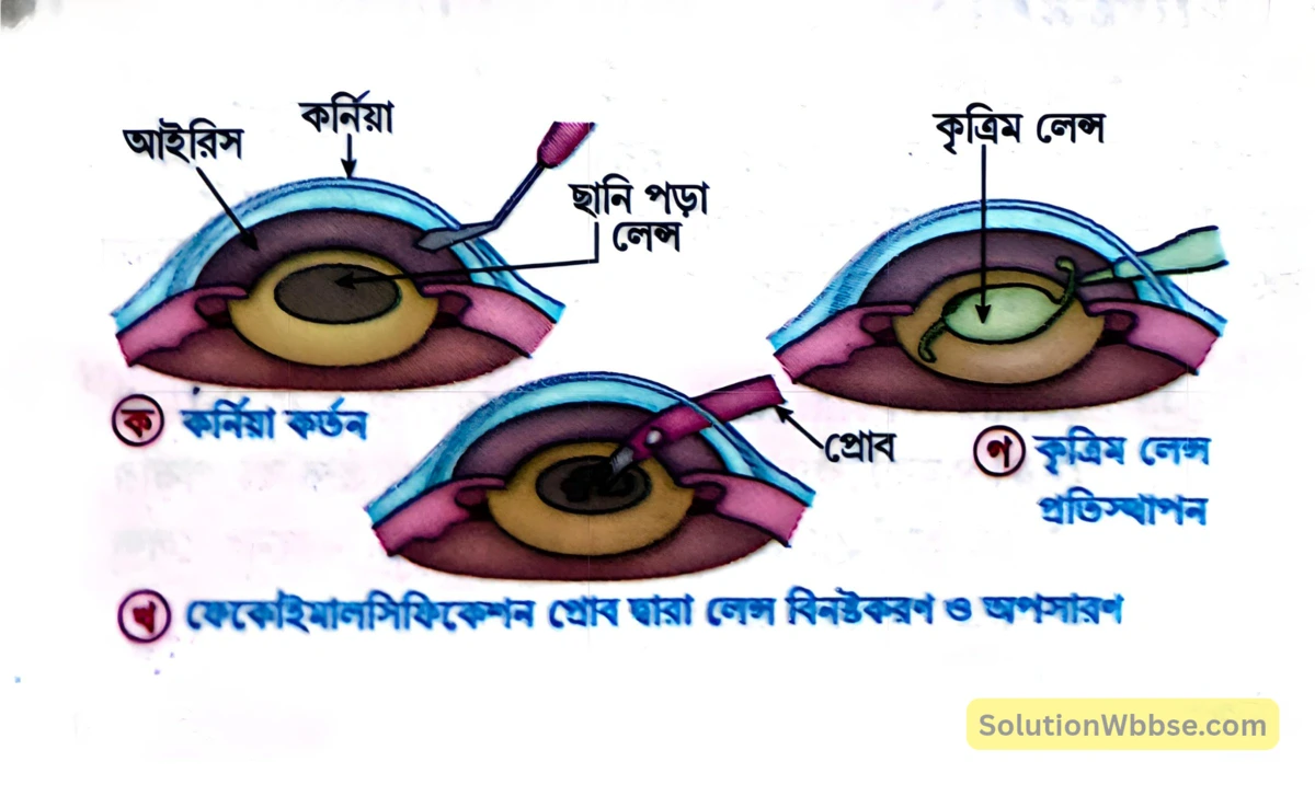 মাধ্যমিক জীবন বিজ্ঞান - জীবজগতে নিয়ন্ত্রণ ও সমন্বয় - প্রাণীদের সাড়াপ্রদান ও ভৌত সমন্বয় - স্নায়ুতন্ত্র - সংক্ষিপ্ত প্রশ্নোত্তর 13 ফেকোইমালসিফিকেশন পদ্ধতিতে ছানি সংশোধন