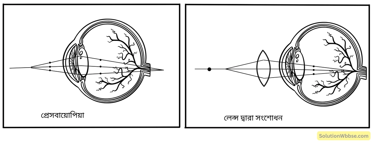 মাধ্যমিক জীবন বিজ্ঞান – জীবজগতে নিয়ন্ত্রণ ও সমন্বয় – প্রাণীদের সাড়াপ্রদান ও ভৌত সমন্বয় - স্নায়ুতন্ত্র - রচনাধর্মী প্রশ্নোত্তর 16 প্রেসবায়োপিয়া-ত্রুটি ও সংশোধন-