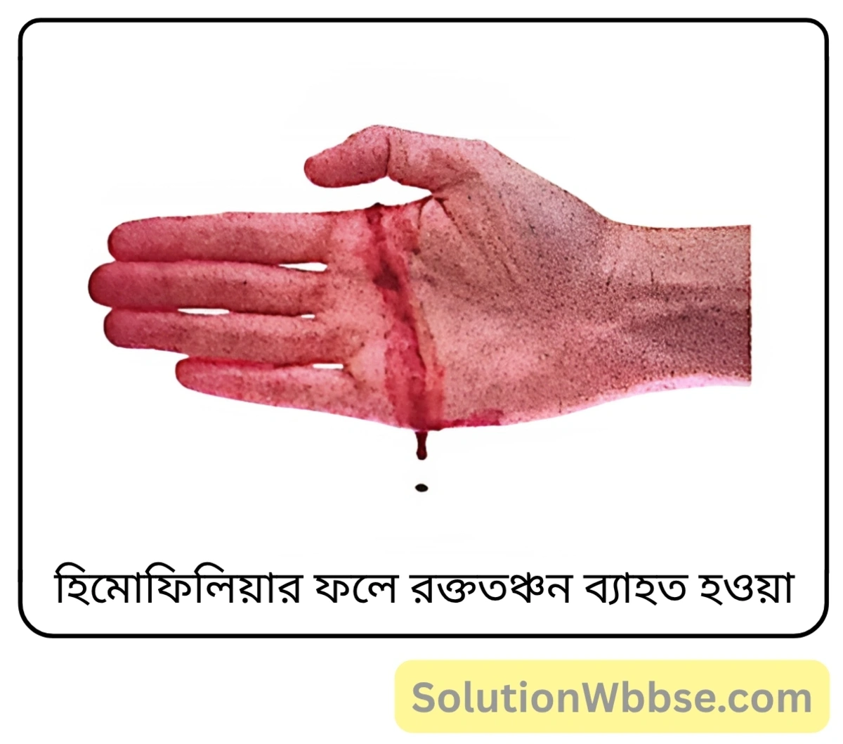 হিমোফিলিয়ার ফলে রক্ততঞ্চন ব্যাহত হওয়া