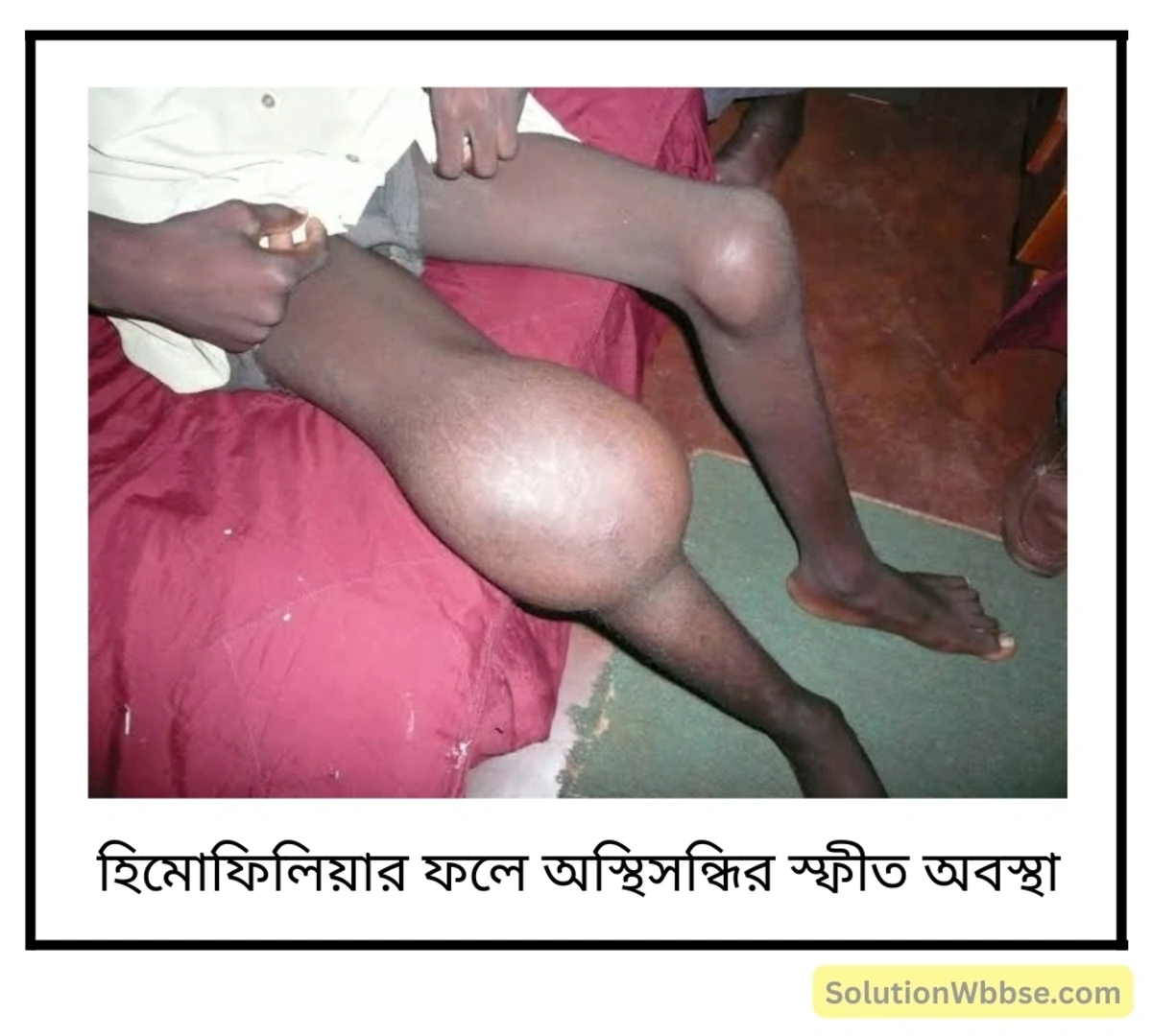হিমোফিলিয়া