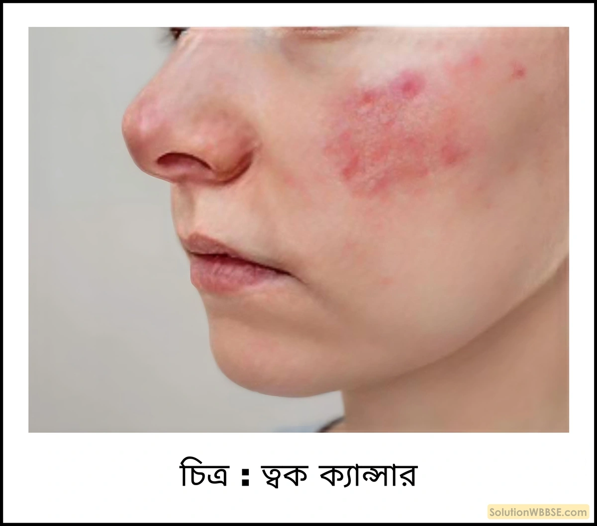 স্বাস্থ্য ও পরিবেশের ওপর ওজোন স্তর ধ্বংসের ক্ষতিকারক প্রভাব উল্লেখ করো।