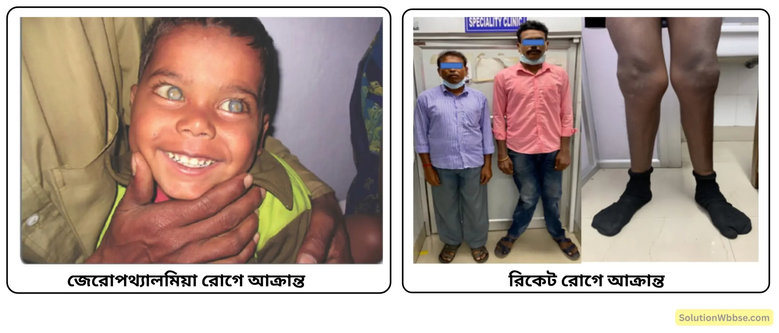 নবম শ্রেণী জীবনবিজ্ঞান - জীবন সংগঠনের স্তর - জৈব অণু এবং তাদের বৈশিষ্ট্য - রচনাধর্মী প্রশ্ন ও উত্তর 23 জেরোপথ্যালমিয়া রোগ ও আক্রান্ত রিকেট রোগে আক্রান্ত