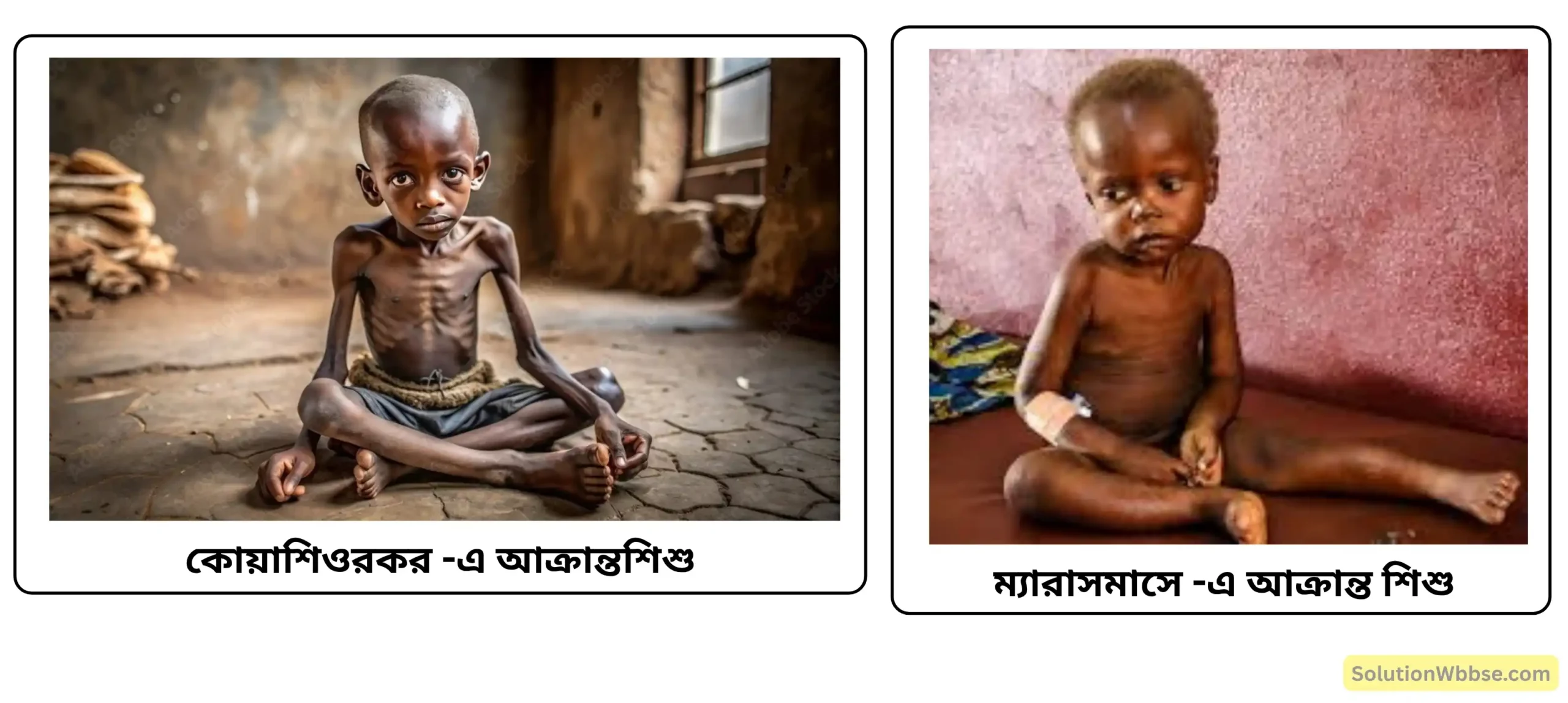 প্রোটিন ও ক্যালোরিজনিত অপুষ্টি