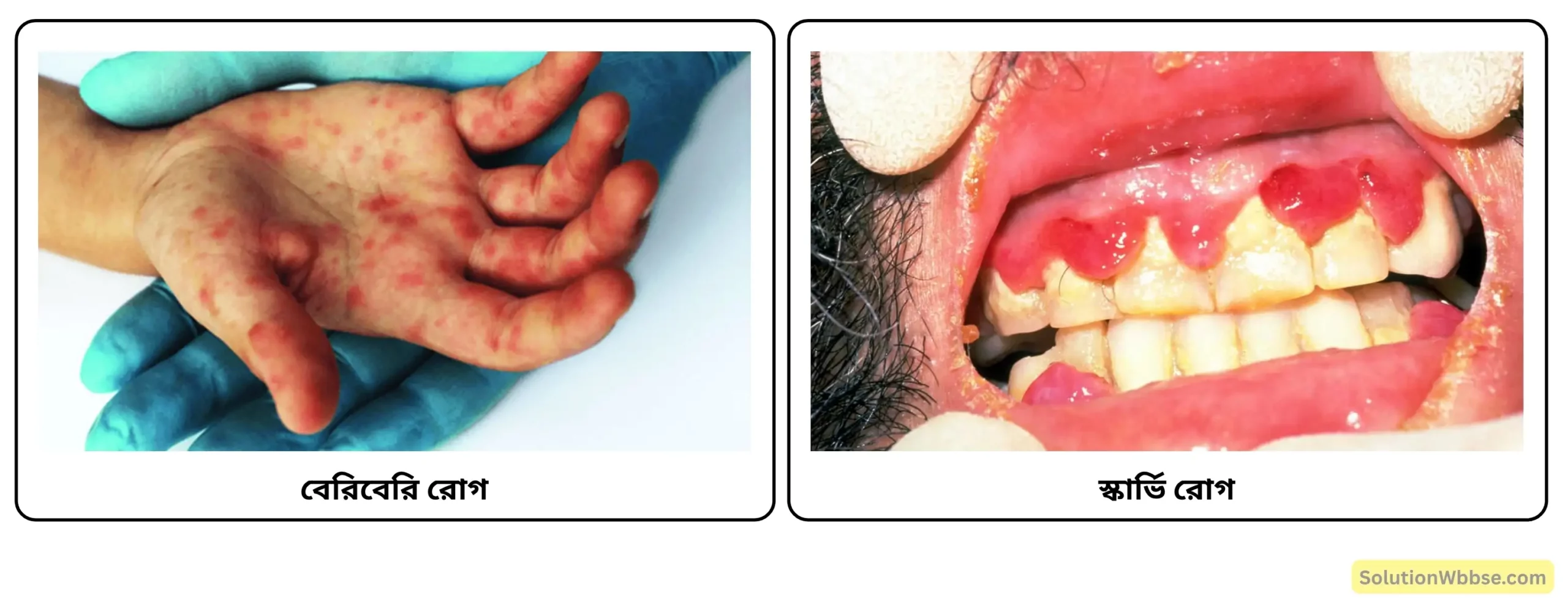 নবম শ্রেণী জীবনবিজ্ঞান - জীবন সংগঠনের স্তর - জৈব অণু এবং তাদের বৈশিষ্ট্য - রচনাধর্মী প্রশ্ন ও উত্তর 24 বেরিবেরি রোগে ও আক্রান্ত স্কার্ভি রোগে আক্রান্ত
