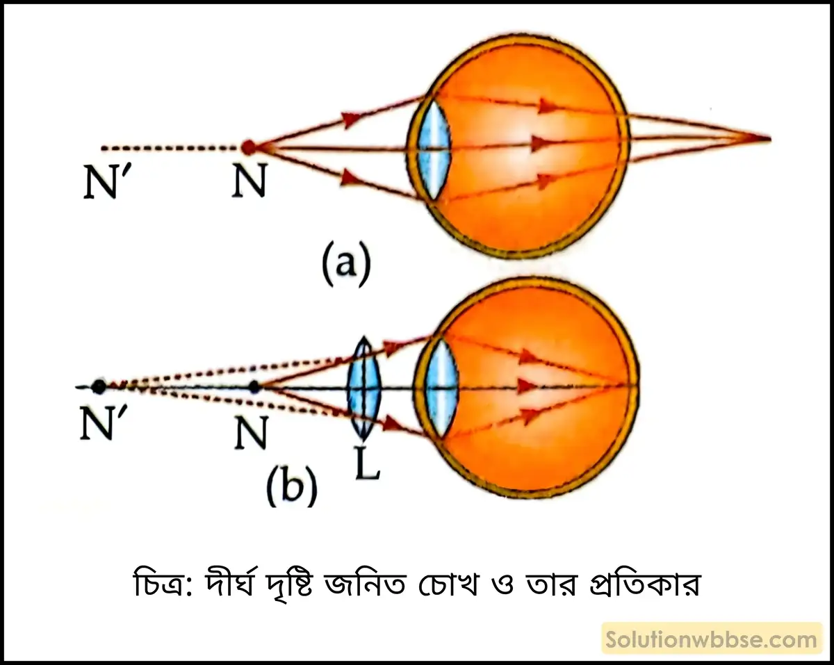 দীর্ঘ দৃষ্টি জনিত চোখ ও তার প্রতিকার