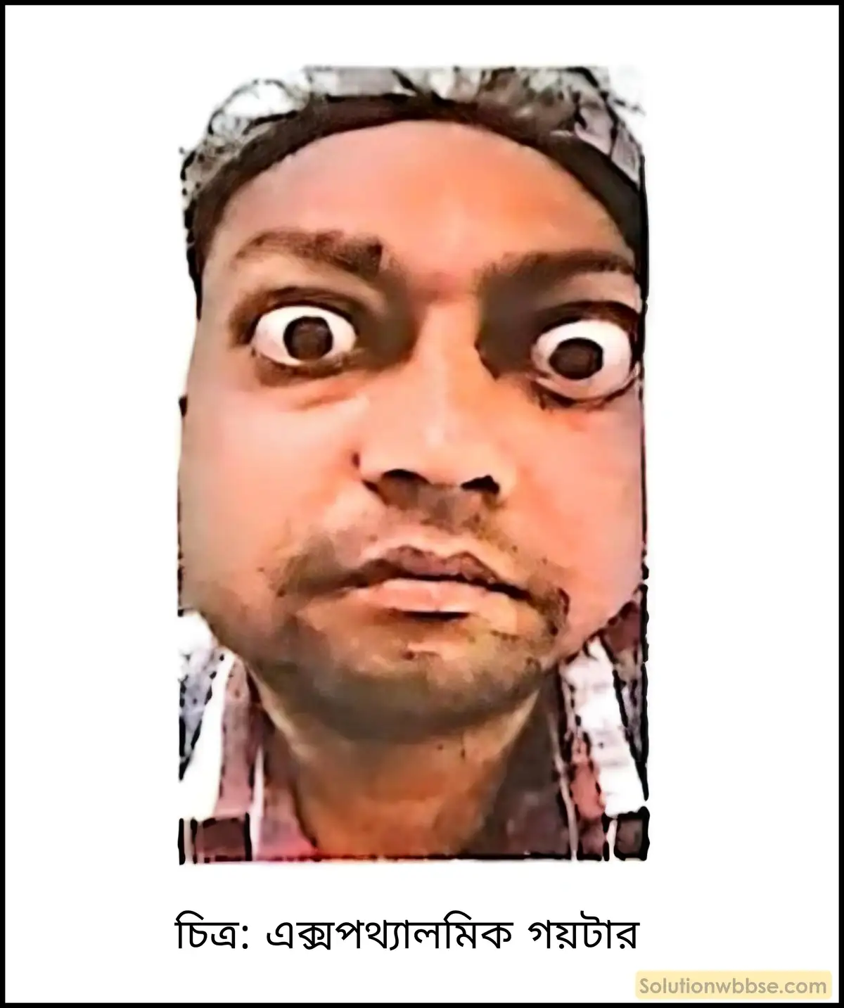 এক্সপথ্যালমিক গয়টার বা বহিঃচক্ষু গলগণ্ড কী? এক্সপথ্যালমিক গয়টারের উপসর্গ কী কী? 2 এক্সপথ্যালমিক গয়টার