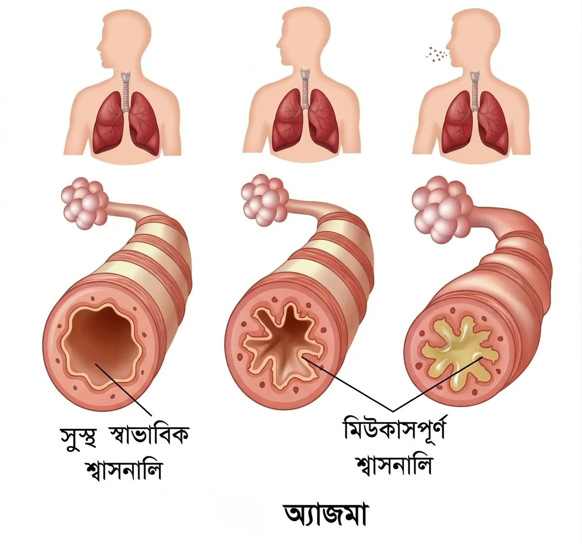 অ্যাজমা